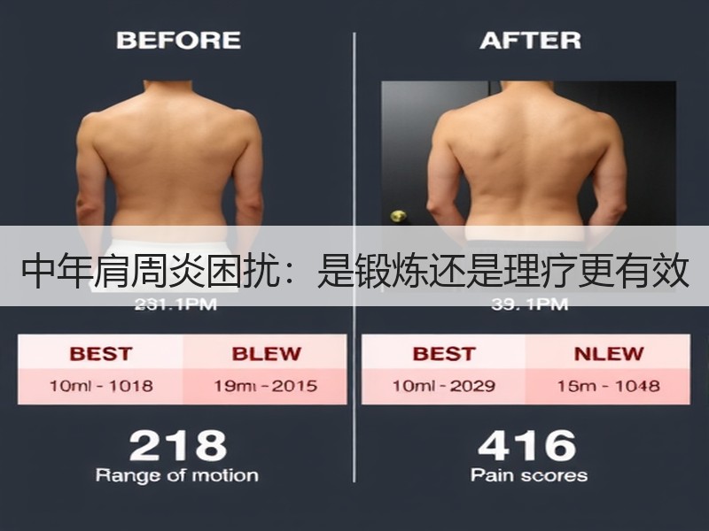 中年肩周炎困扰：是锻炼还是理疗更有效